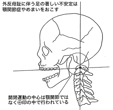 外反母趾に伴う足の著しい不安定は顎関節症やめまいをおこす