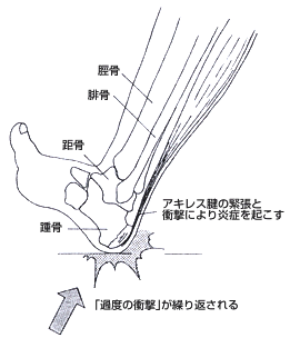 過度の衝撃が繰り返される