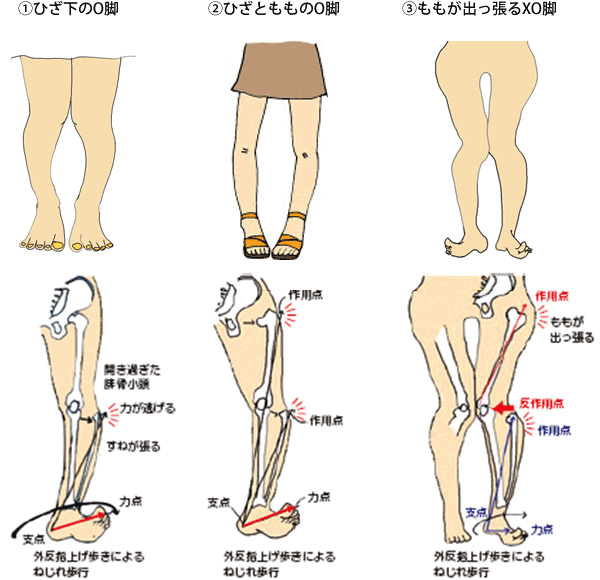 外反母趾とo脚 下半身ダイエット