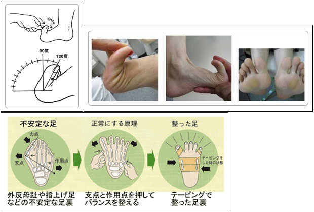 テーピングで整った足裏